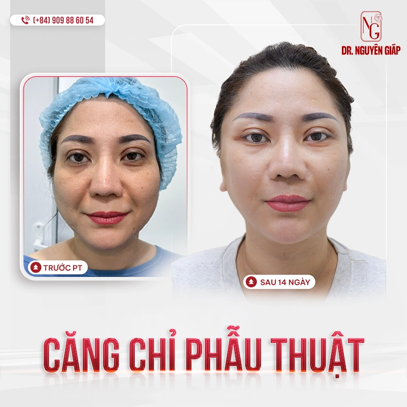 cang-chi-collagen-va-cay-mo Khách hàng thực hiện Căng chỉ và cấy mỡ tại BS Nguyên Giáp