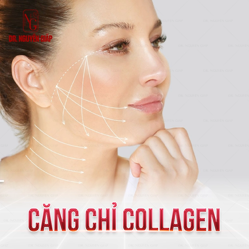 Căng chỉ collagen trẻ hòa toàn diện gương mặt