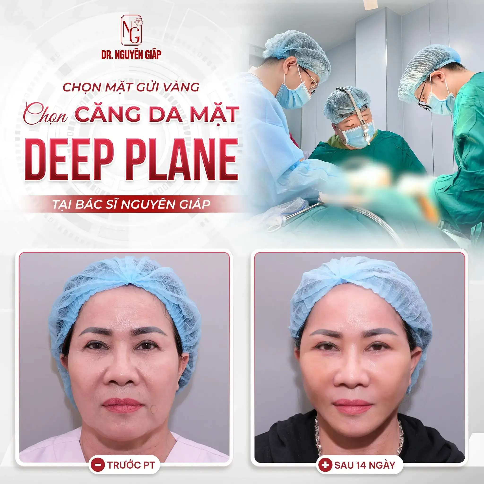 Chọn căng da mặt chọn Bác sĩ Nguyên Giáp