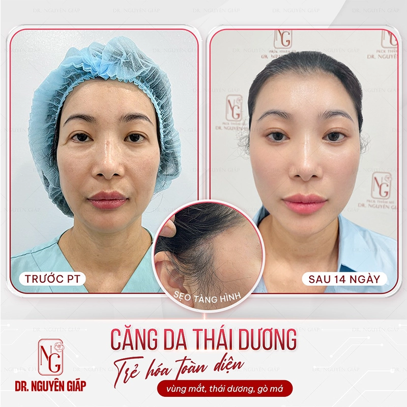 Căng da mặt mini cang da mini 1