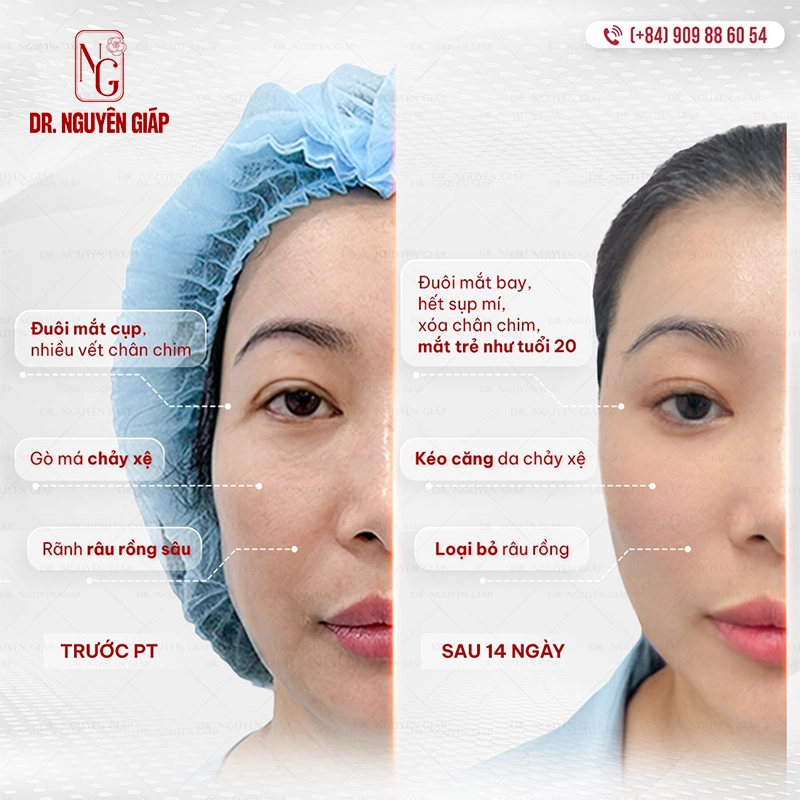 Căng da mặt mini Hiệu quả ấn tượng của căng da mặt mini