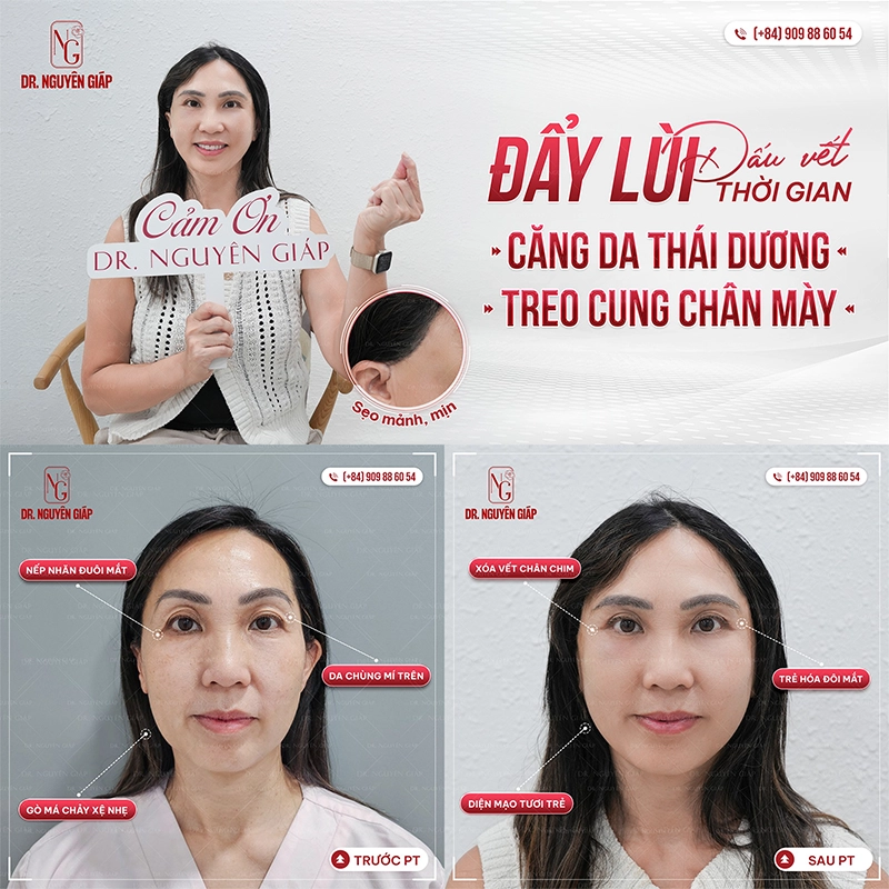 Căng da mặt mini cang da mini 3