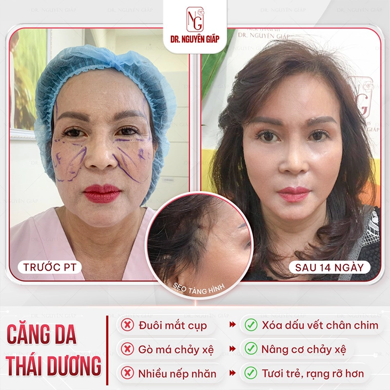 Căng da mặt mini cang da mini 4