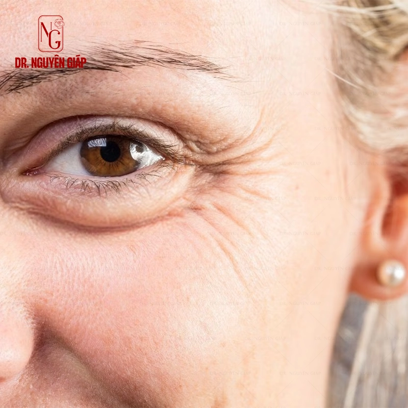 Căng da mặt mini cang da mini 6