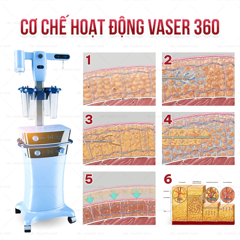 Hút mỡ Vaser 360- Kiến tạo vóc dáng và chuẩn mực an toàn quốc tế Hệ thống Vaser 360 hoạt động dựa trên cơ chế sóng siêu âm nhũ hóa mỡ