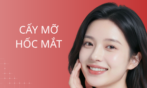 dich-vu-cay-mo-hoc-mat