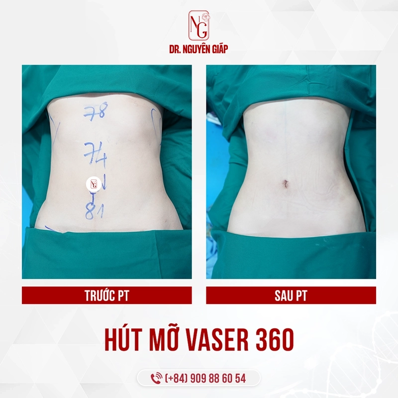 Hút mỡ Vaser 360- Kiến tạo vóc dáng và chuẩn mực an toàn quốc tế hut mo vaser 360 1