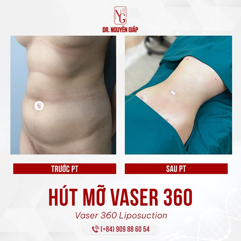 Hút mỡ Vaser 360- Kiến tạo vóc dáng và chuẩn mực an toàn quốc tế Hút mỡ Vaser 360 eo thon hết cỡ