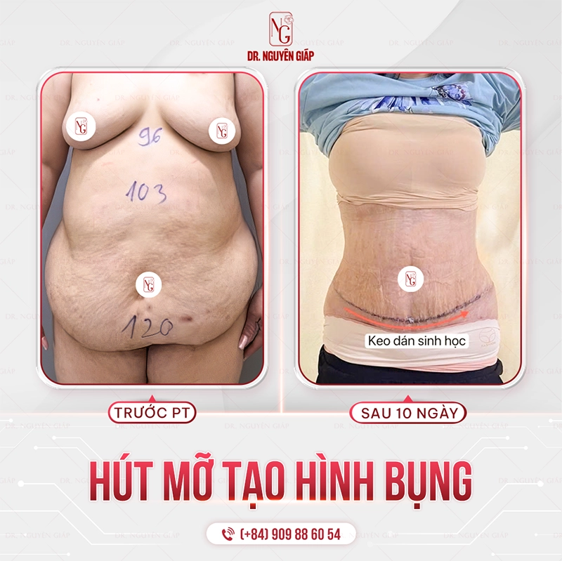 Hút mỡ Vaser 360- Kiến tạo vóc dáng và chuẩn mực an toàn quốc tế hut mo vaser 360 tao hinh bung 1