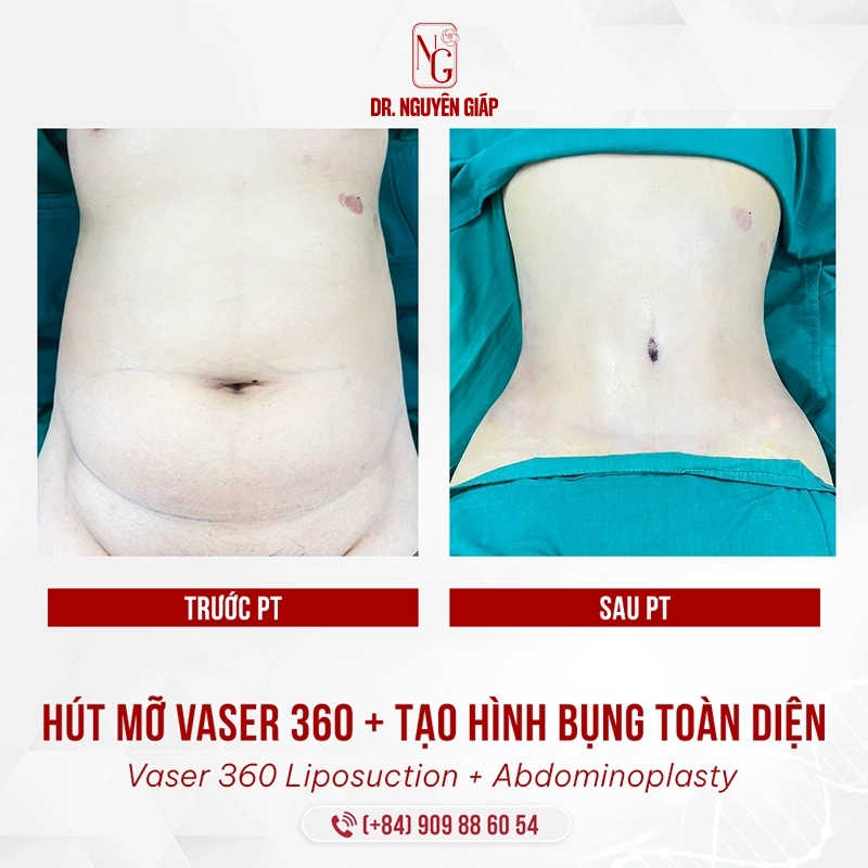 Hút mỡ Vaser 360- Kiến tạo vóc dáng và chuẩn mực an toàn quốc tế hut mo vaser 360 tao hinh bung 3