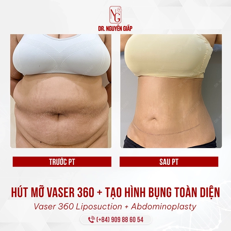 Hút mỡ Vaser 360- Kiến tạo vóc dáng và chuẩn mực an toàn quốc tế hut mo vaser 360 tao hinh bung