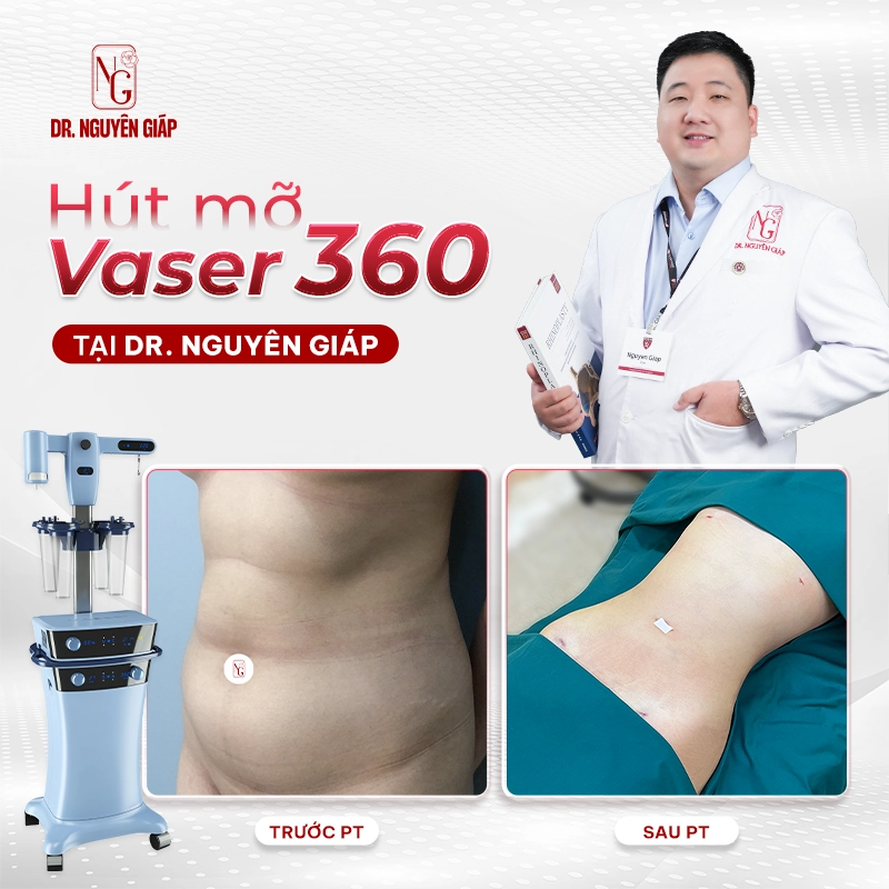 Hút mỡ vaser 360 tại Dr. Nguyên Giáp