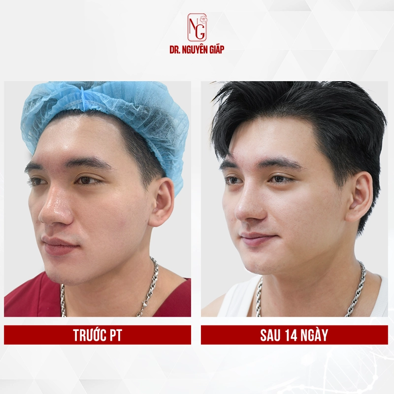 Dáng mũi L-line phù hợp với gương mặt nam