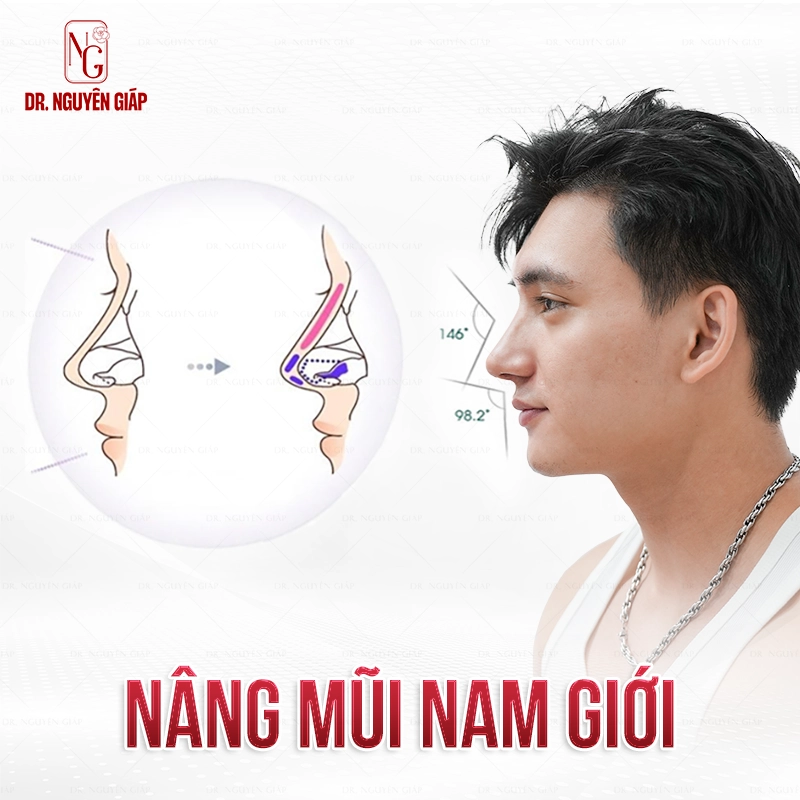 Nâng mũi nam giới kiến tạo phong cách phái mạnh