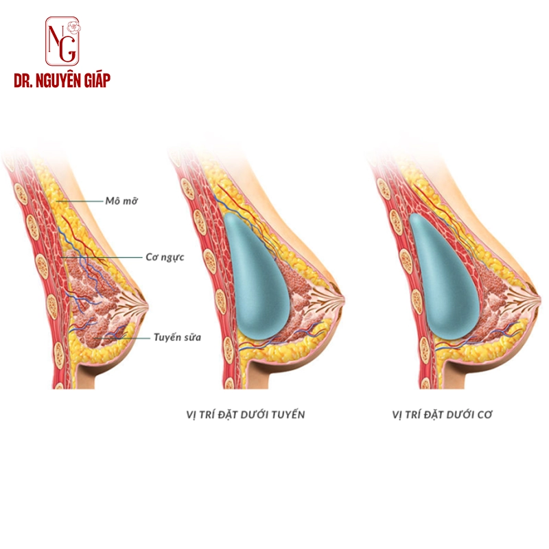 Mô phỏng vị trí đặt túi ngực