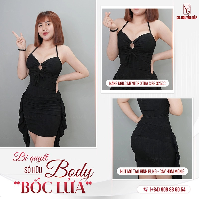 Body cực bốc sau 2 tuần hút mỡ