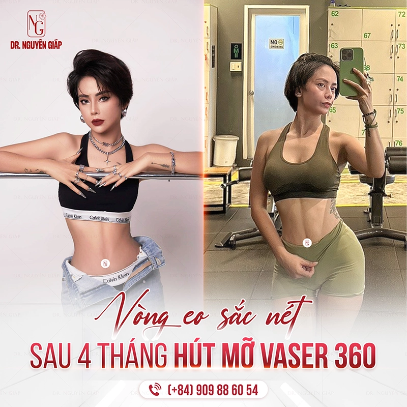 Kết quả hút mỡ sau 4 tháng