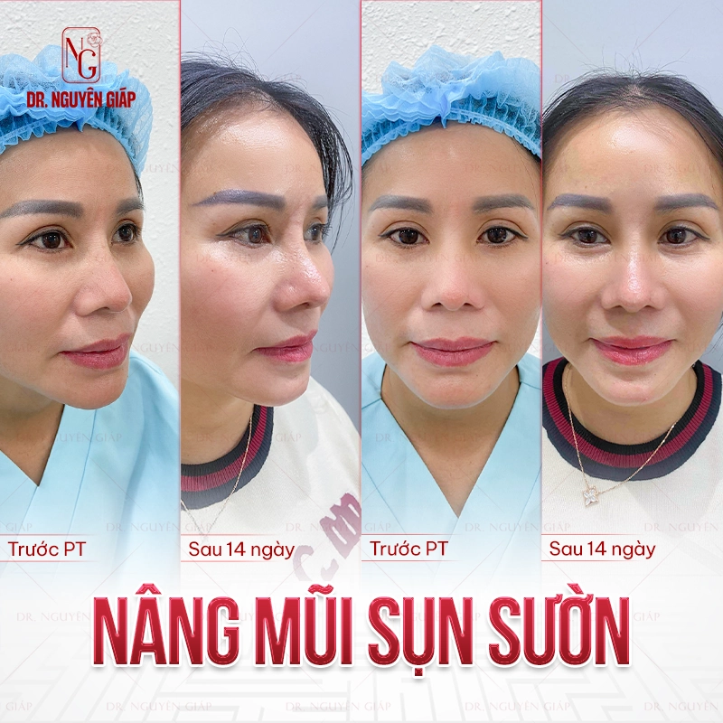 Khách hàng nâng mũi sụn sườn tại Dr. Nguyên Giáp