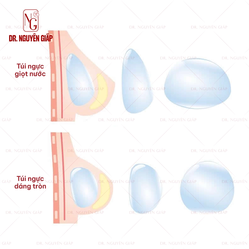 Mo-phong-tui-nguc-giot-nuoc-vs-dang-tron Mô phỏng túi ngực giọt nước với dáng tròn