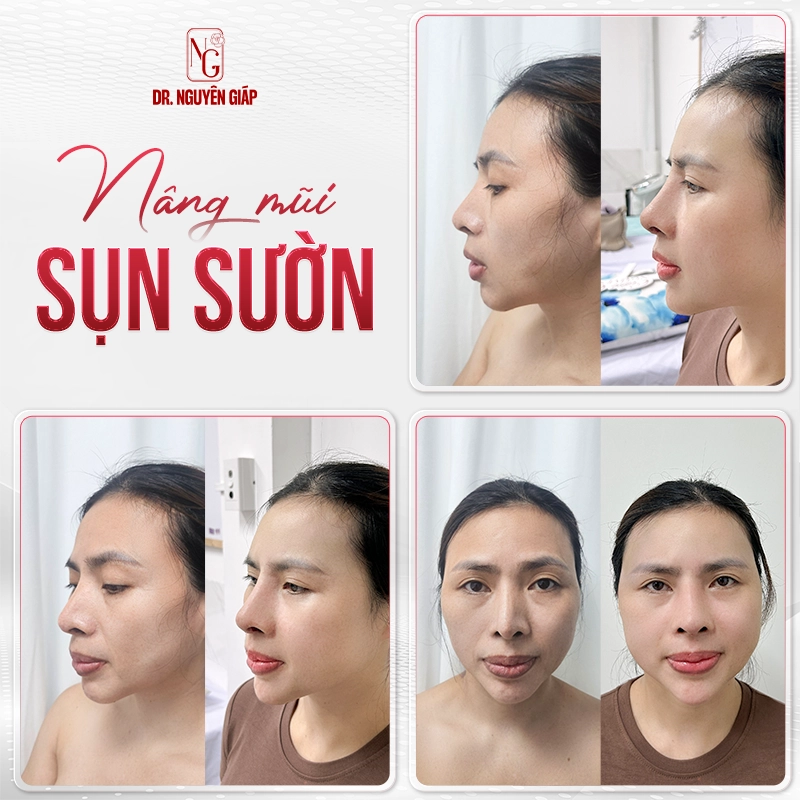 Dáng mũi sụn sườn 14 ngày siêu đẹp của khách hàng Dr. Nguyên Giáp