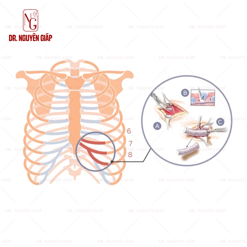 Mô phỏng vị trí lấy sườn nâng mũi