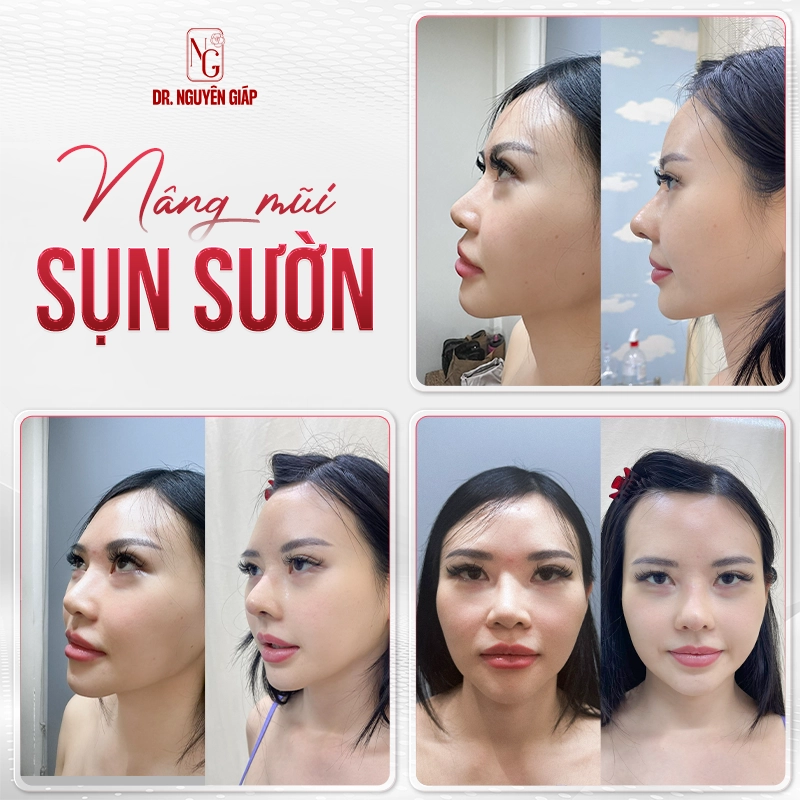 Nâng mũi sụn sườn là gì? Cẩm nang từ A-Z về phương pháp nâng mũi tự thân Dáng mũi sụn sườn của khách hàng Bác sĩ Nguyên Giáp