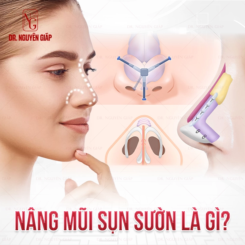 Nâng mũi sụn sườn là gì? Cẩm nang từ A-Z về phương pháp nâng mũi tự thân