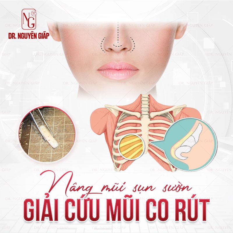 Giải cứu mũi co rút, ngắn hếch bằng nâng mũi sụn sườn
