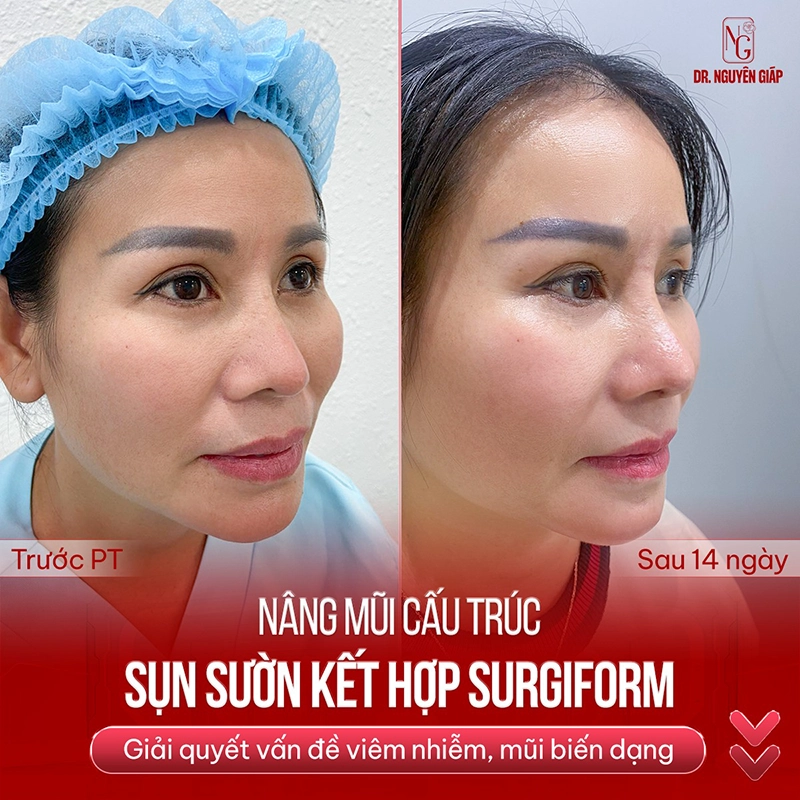 bien-chung-nang-mui-sun-suon-1 Kết quả nâng mũi sụn sườn bền vừng của khách hàng Dr. Nguyên Giáp