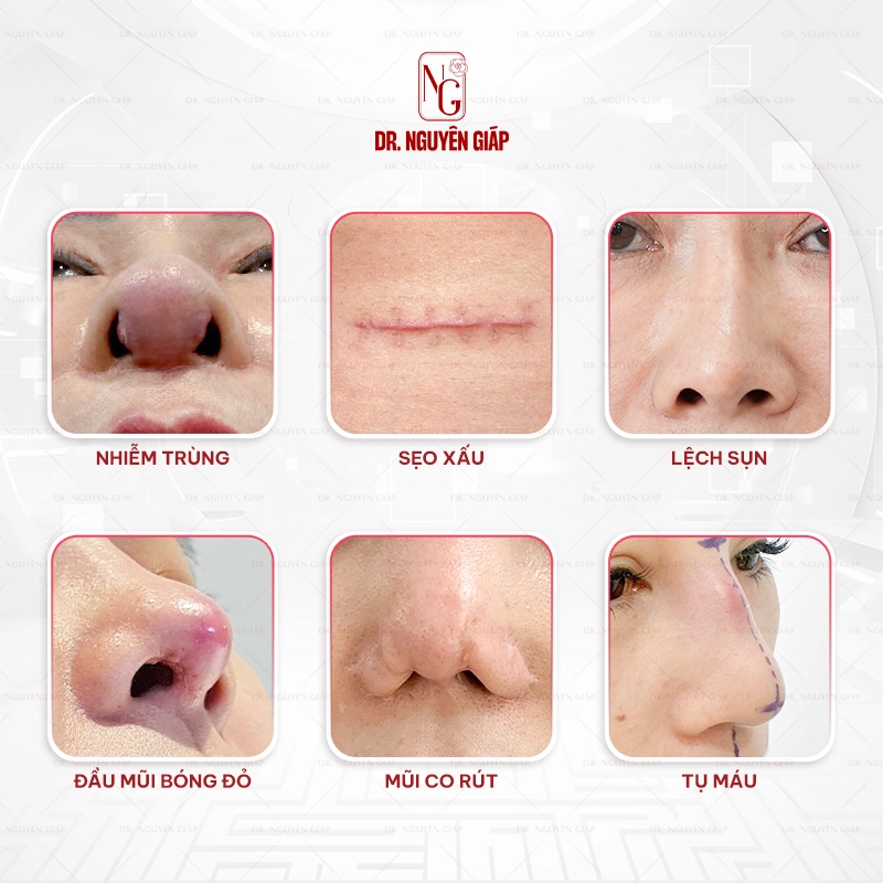 bien-chung-nang-mui-sun-suon-2 Những biến chứng nâng mũi sụn sườn thường gặp