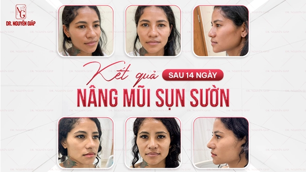 Quá trình 14 ngày hồi phục sau nâng mũi sụn sườn