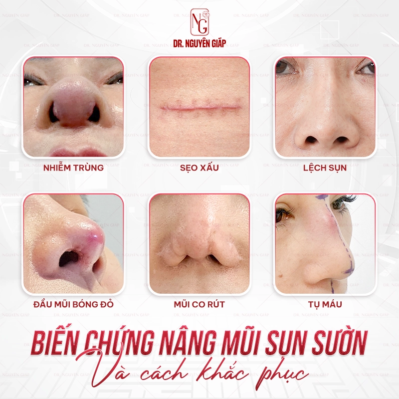 6 biến chứng nâng mũi sụn sườn và cách khắc phục