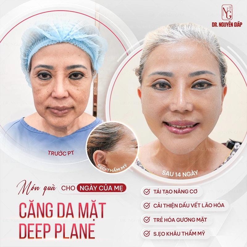 cang-da-mat-4 Khách hàng tươi trẻ, xinh đẹp sau căng da mặt