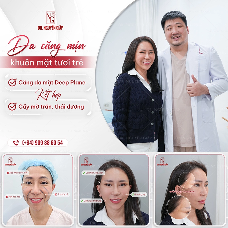 cang-da-mat-5 Bác sĩ Nguyên Giáp sở hữu một nền tảng vừng chắc về căng da mặt Deep Plane