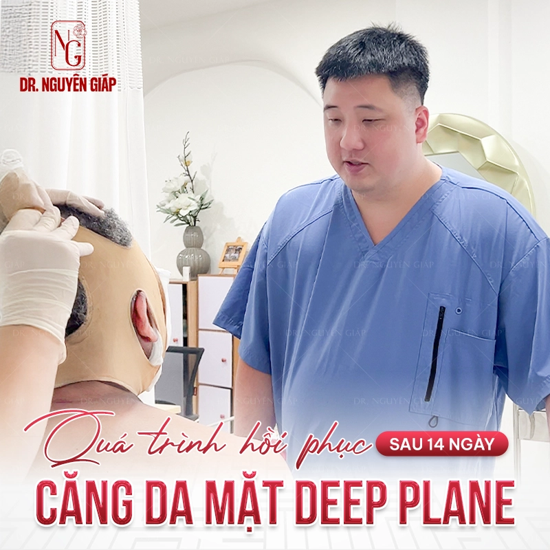 Quá trình hồi phục sau 14 ngày căng da mặt Deep Plane