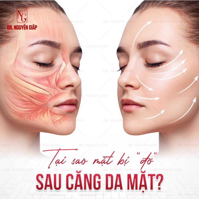 Tại sao mặt bị “đơ” sau căng da mặt và cách bác sĩ Nguyên Giáp khắc phục