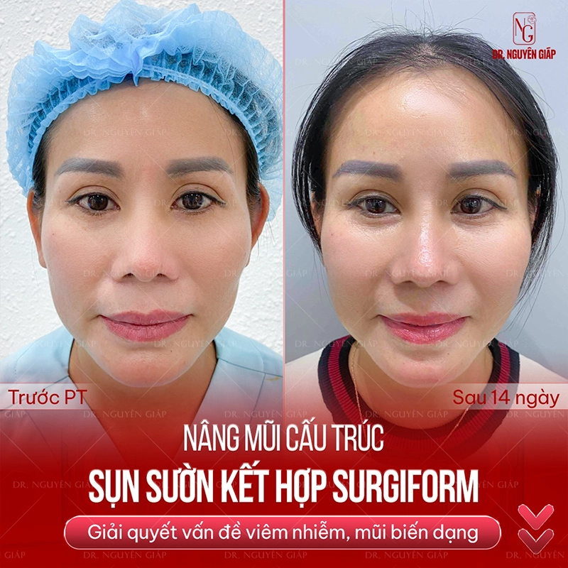 gia-nang-mui-sun-suon-2 Khách hàng nâng mũi sụn sườn tại Dr. Nguyên Giáp