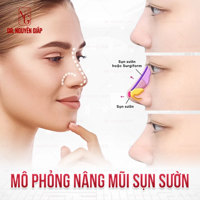 Nâng mũi sụn sườn là gì? Cẩm nang từ A-Z về phương pháp nâng mũi tự thân Nâng mũi sụn sườn kiến tạo dáng mũi cá nhân hóa, ổn định và an toàn