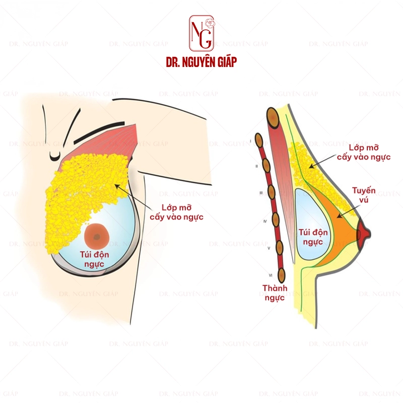 mo-phong-nang-nguc-va-cay-mo Mô phỏng vị trí đặt túi độn nâng ngực kết hợp cấy mỡ tự thân