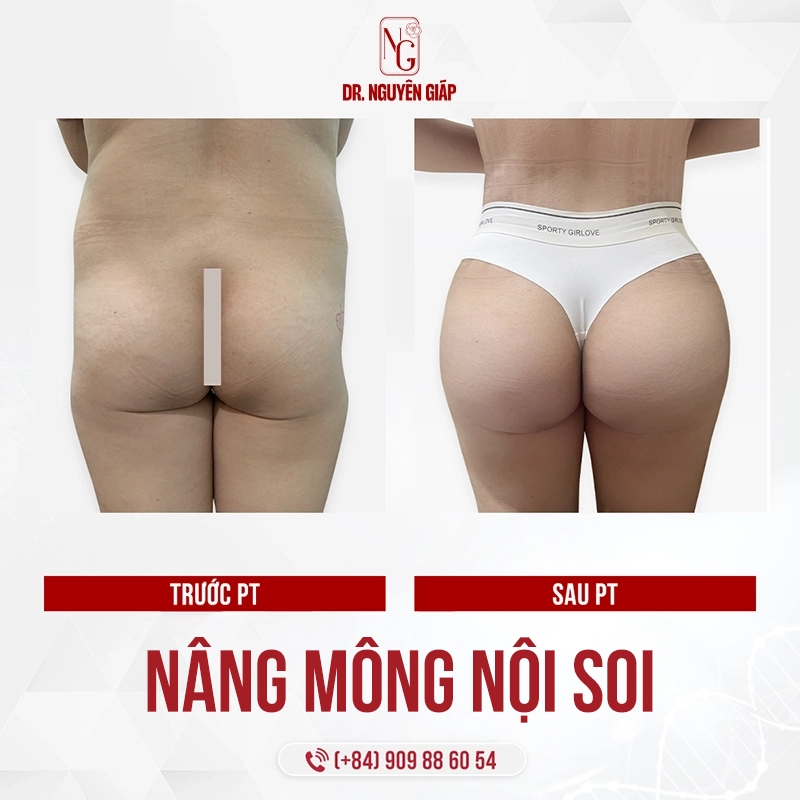 nang-mong-noi-soi-2 Hình ảnh khách hàng nâng mông nội soi tại BS Nguyên Giáp