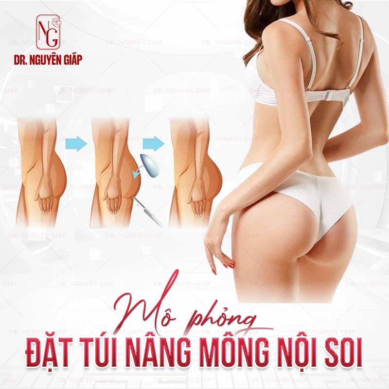 nang-mong-noi-soi-3 Mô phỏng nâng mông nội soi an toàn