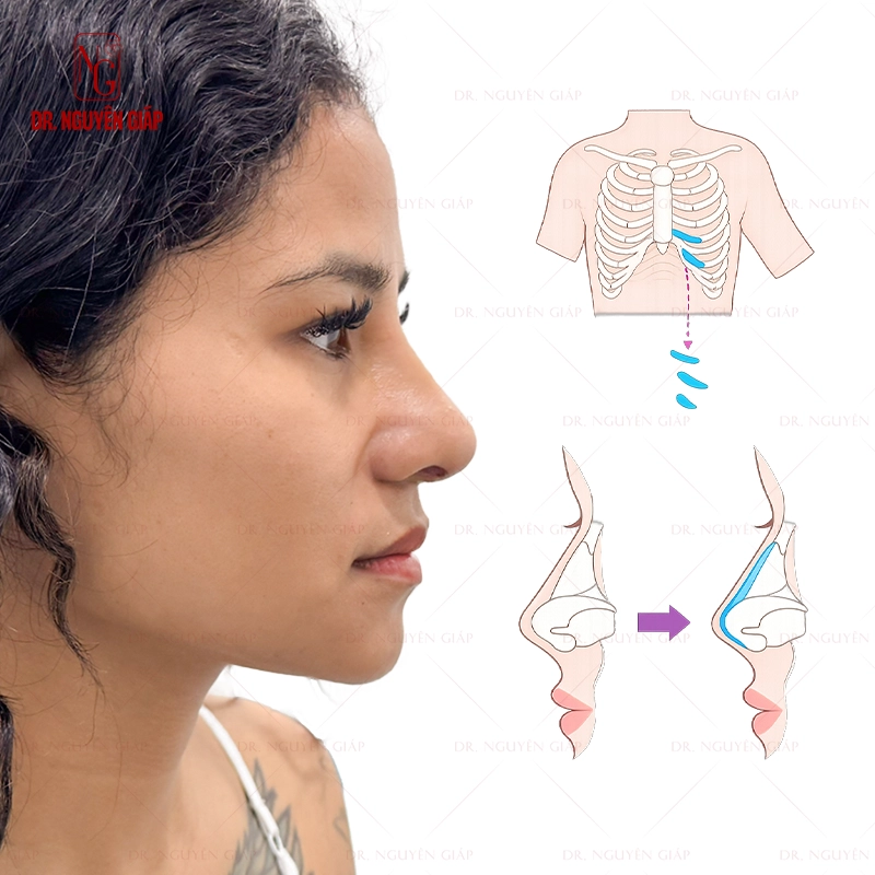 Nâng mũi sụn sườn kiến tạo dáng mũi chuyên sâu và hài hòa hơn