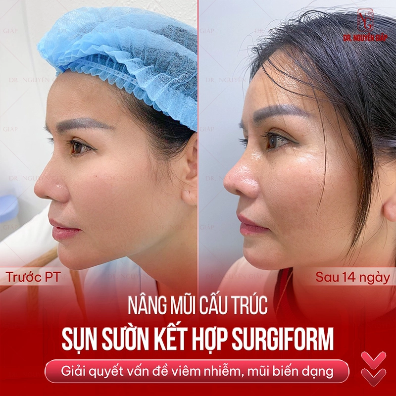 nang-mui-sun-suon-giu-duoc-bao-lau-3 Tái tạo chiếc mũi viêm nhiễm, biến dạng bằng phương pháp nâng mũi sụn sườn tại Dr. Nguyên Giáp