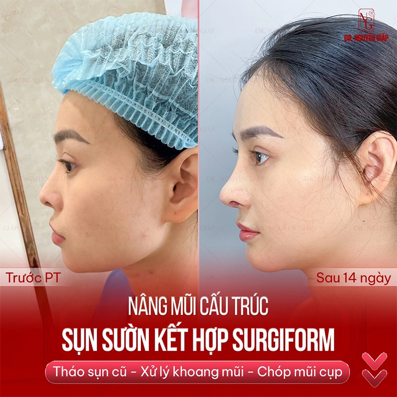 nang-mui-sun-suon-giu-duoc-bao-lau-4 Giải cứu mũi hỏng cụp bằng nâng mũi sụn sườn tại BS Nguyên Giáp