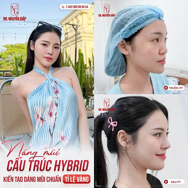 Xinh đẹp tự tin sau 3 tháng nâng mũi sụn tai 