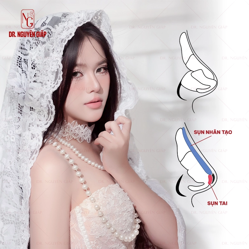 Nâng mũi sụn tai thích hợp hơn cho những khách hàng trẻ tuổi hoặc lần đầu nâng mũi.