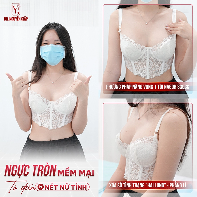 Đẹp tự tin với vòng 1 căng tròn sau 6 tháng nâng cấp tạo BS Nguyên Giáp