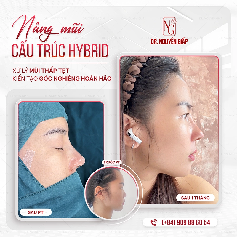 Phẫu thuật tạo hình mũi là mootk kỹ thuật đòi hỏi sự phối hợp nhịp nhàng giữa yếu tố nghệ thuật và giới hạn an toàn y khoa