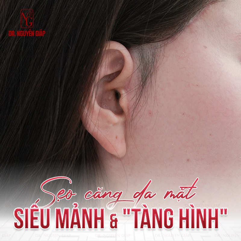 Kỹ thuật khâu giấu sẹo căng da mặt tại Dr. Nguyên Giáp