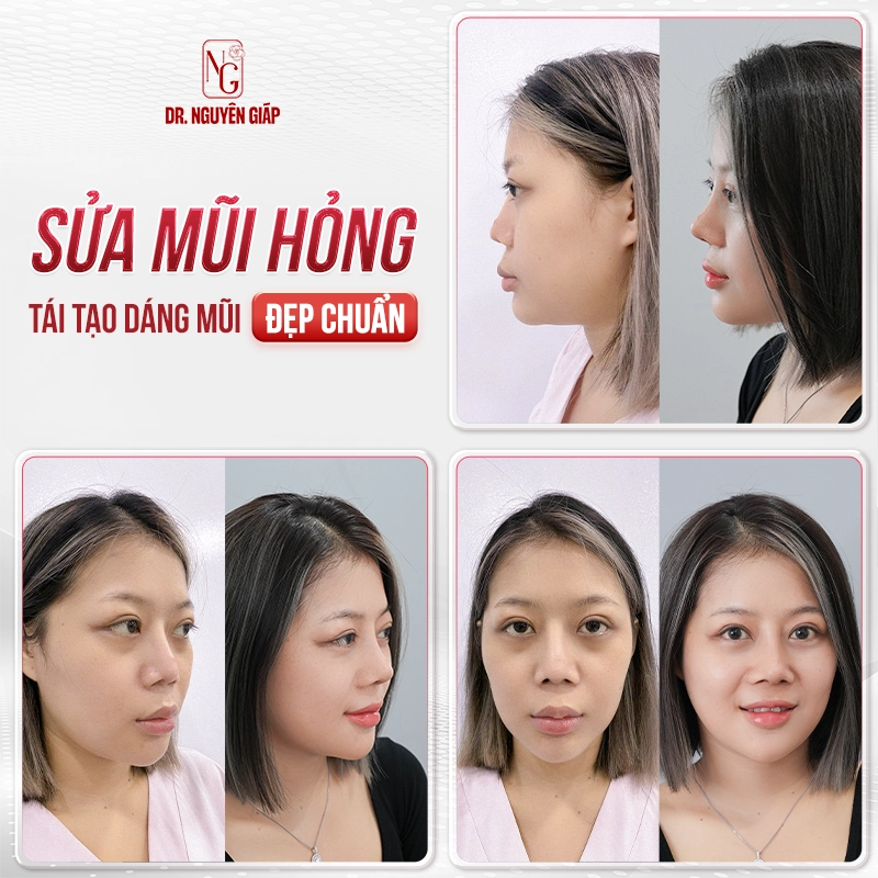 sua-bien-chung-mui-3 Dáng mũi thanh tú của khách hàng BS Nguyên Giáp